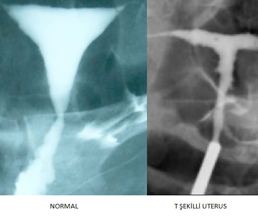 Açıklanamayan İnfertilitenin Ve Tekrarlayan Gebelik Kayıplarını Az Bilinen Nedeni T Şekilli Uterus